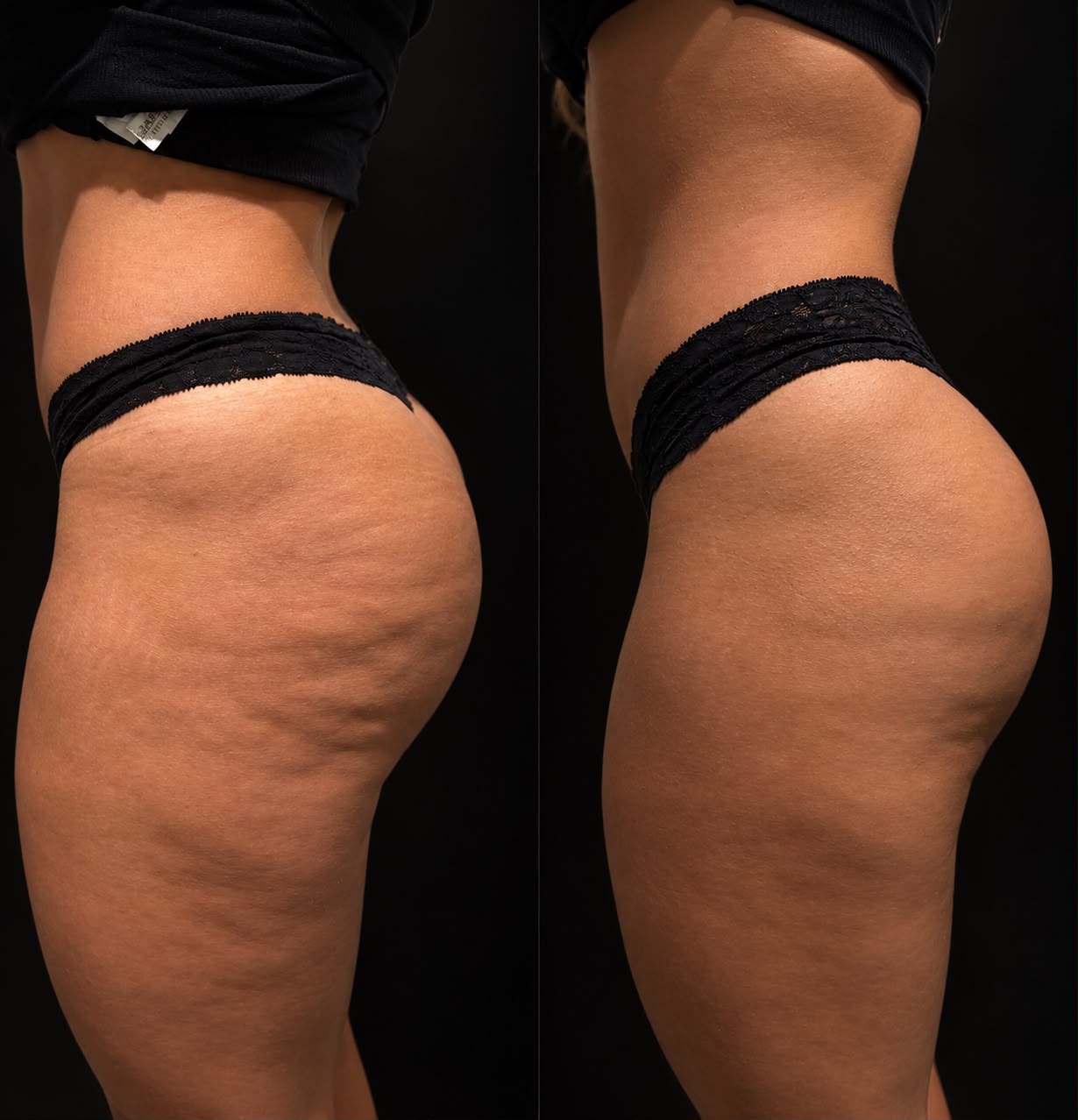 Comparação fotográfica real: antes à esquerda e depois à direita, mostrando a região lateral do quadril e da coxa, com a textura da pele preservada.